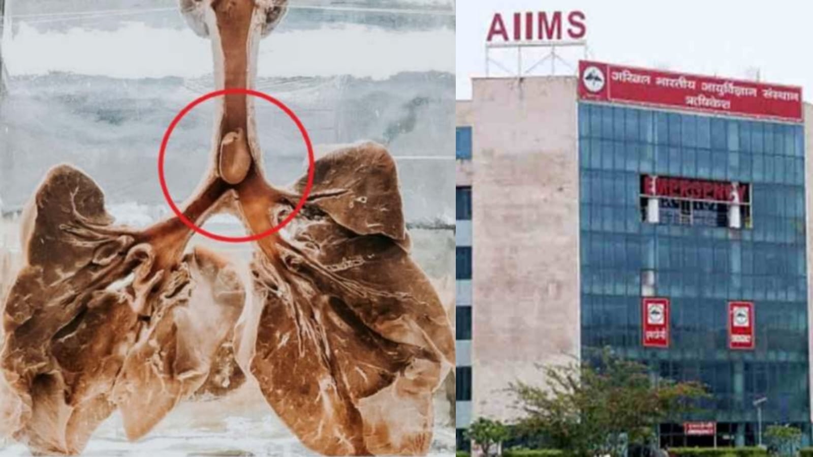 AIIMS doctors remove peanut stuck in girl's trachea for 12 days